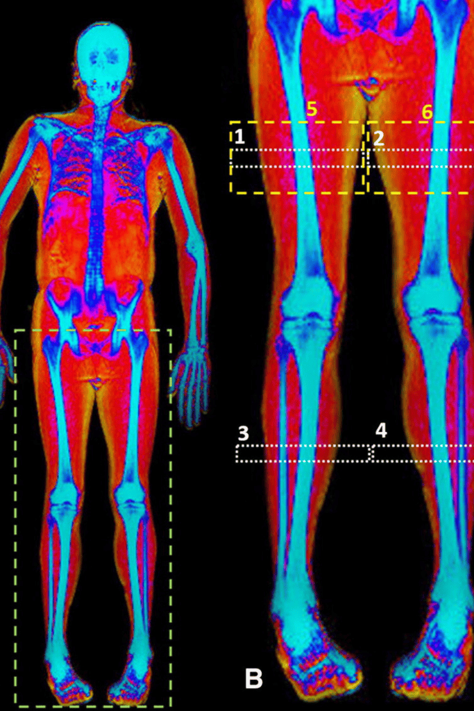 Dexa Scan Bone Density I Thrive