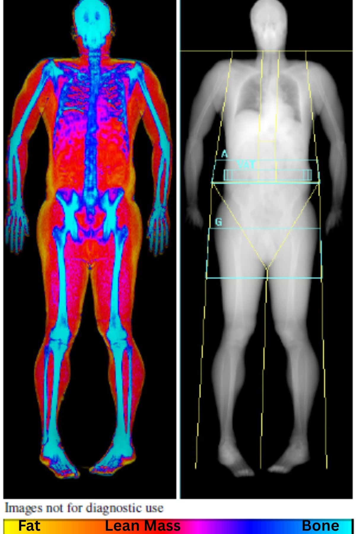 Hologic Dexa Body Composition Scan Image